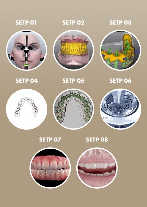 Dental Implant Procedure Step-By-Step