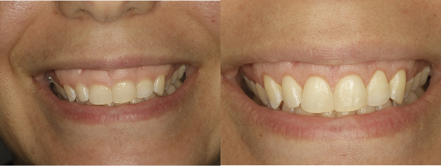 Gum Contouring