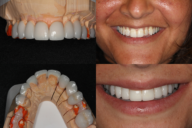 Porcelain Veneers