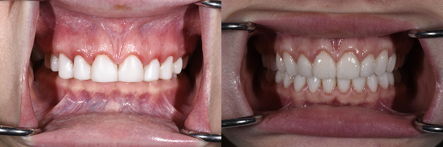 Smile Makeover