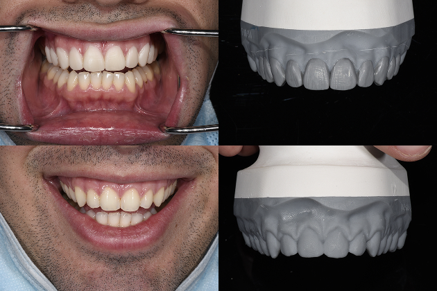 Tooth Contouring & Reshaping