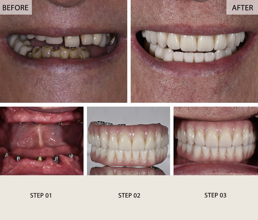 Full Mouth Dental Implants Before and After Pictures Step-by-Step Transformation Gallery